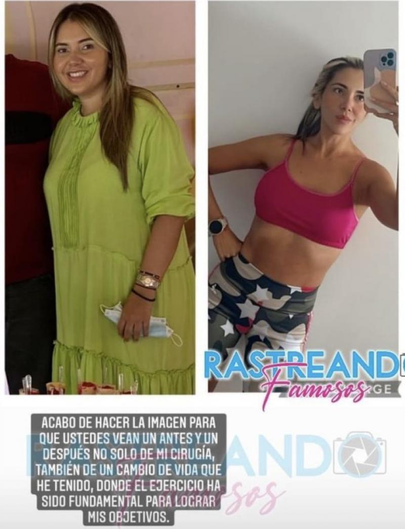 Dayana Jaimes Hace Sorprendente Comparativa Del Antes Y Después De Su Cirugía Bariátrica